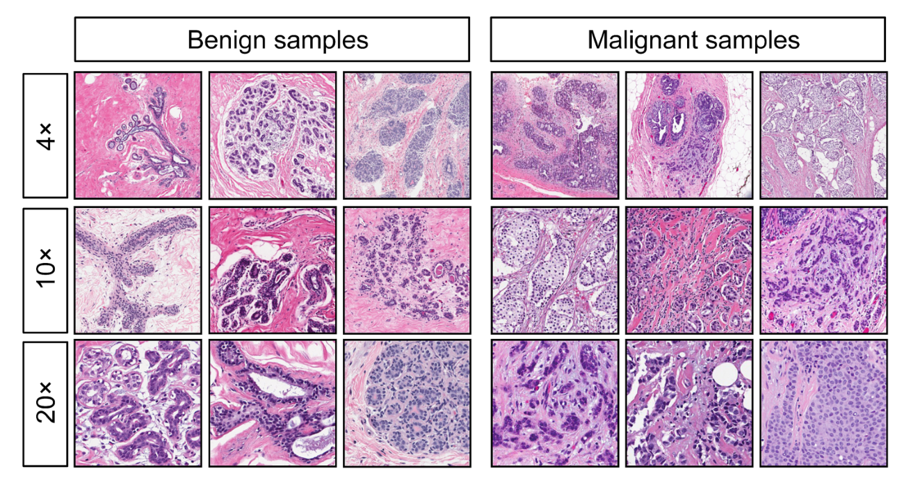 Breast Cancer Dataset 